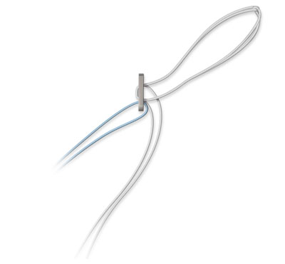 ACL TightRope® Implant