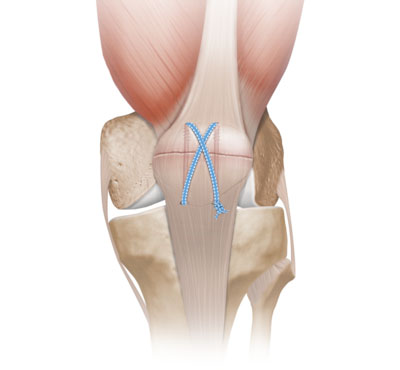 Patella Fracture System