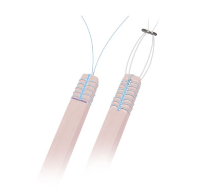 FiberLoop® con sutura FiberTag™