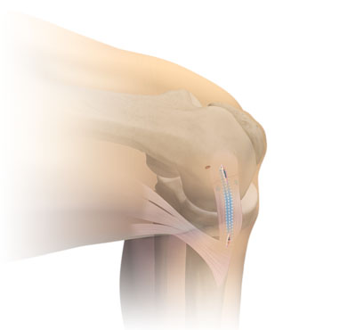 InternalBrace™ Procedure For A Medial Collateral Ligament (MCL) Repair